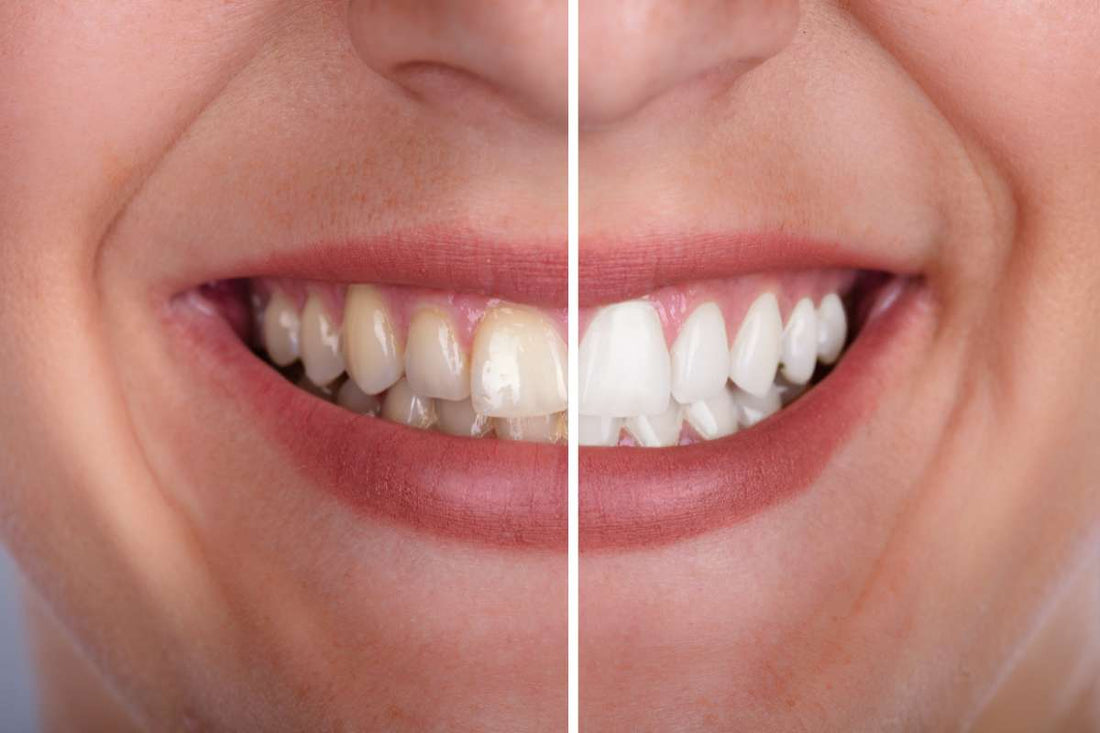 Image of a woman's mouth showing before and after photos of teeth whitening ready to compare Beyond Ultra with Zoom WhiteSpeed