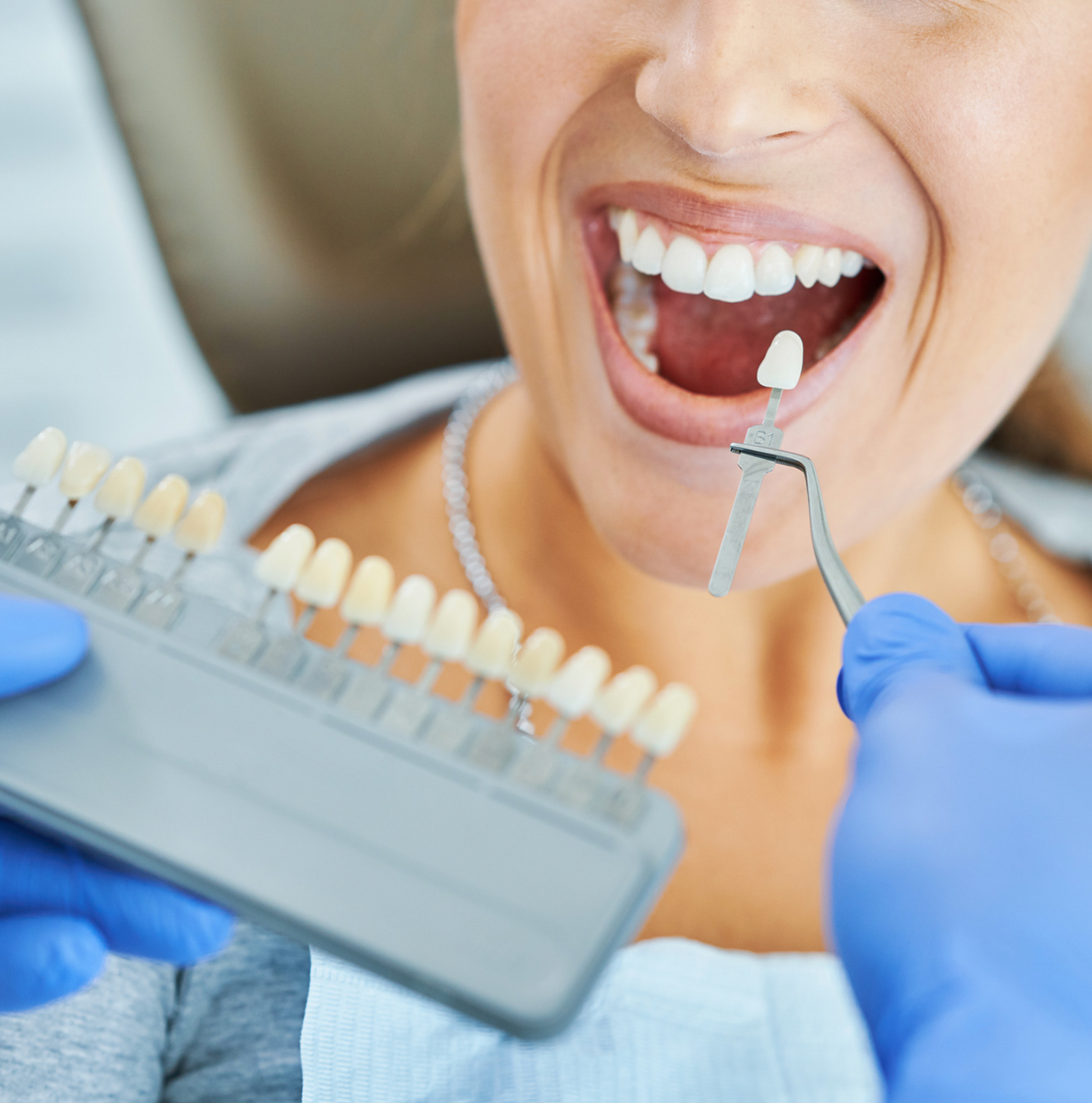 Syringe vs. Pen: Choosing the Right Vessel for Chairside Whitening