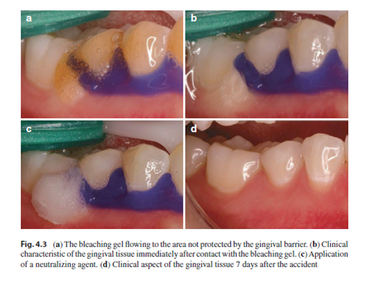 Tooth Whitening: An Evidence-Based Perspective, Second Edition